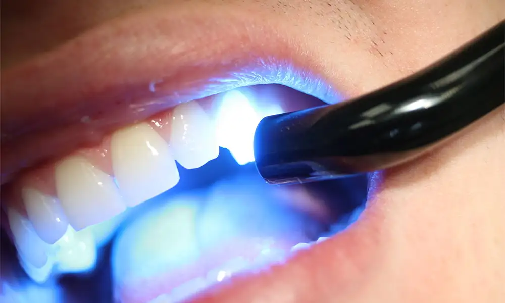 Реставрация зубов светоотверждающими нанокомпозитными материалами 